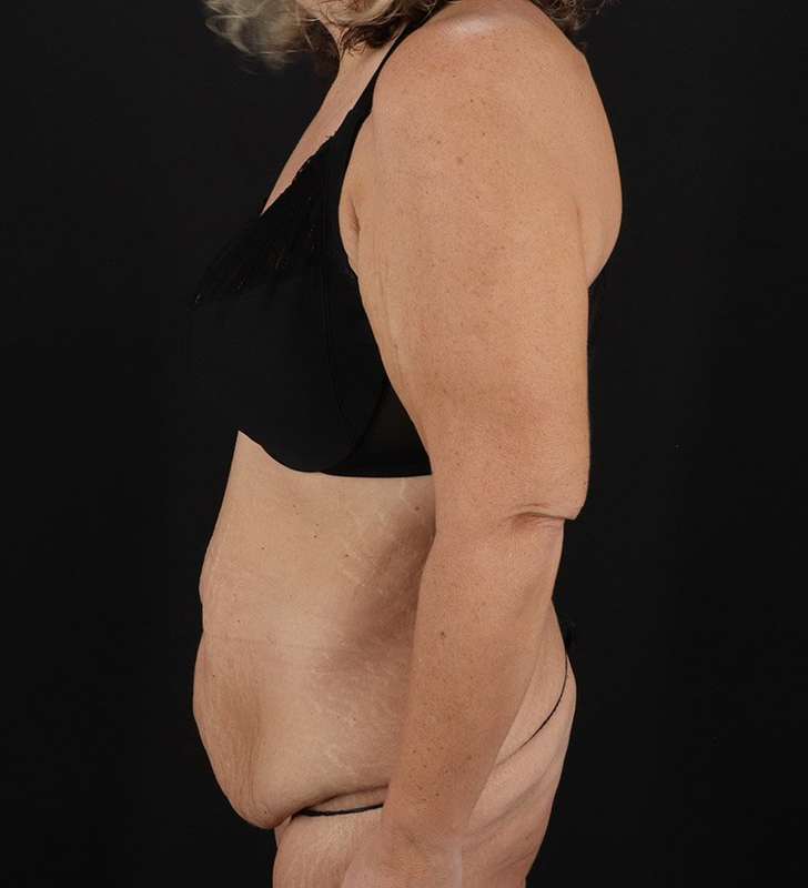 Tummy Tuck Before & After Patient #2326
