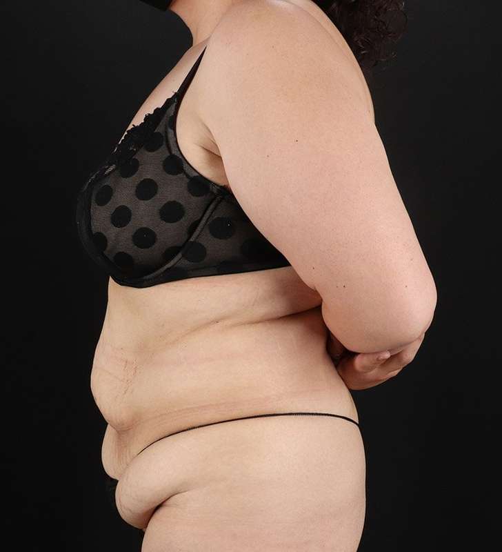 Tummy Tuck Before & After Patient #2339