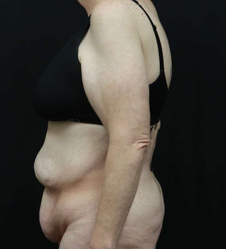 Tummy Tuck Before & After Patient #2363