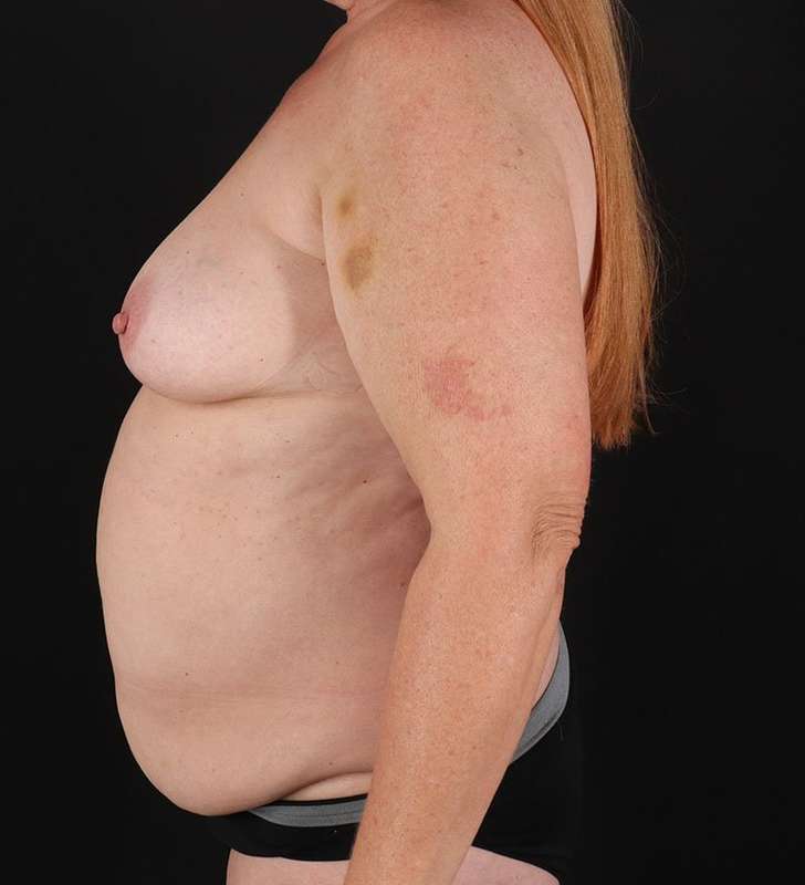 Tummy Tuck Before & After Patient #2376