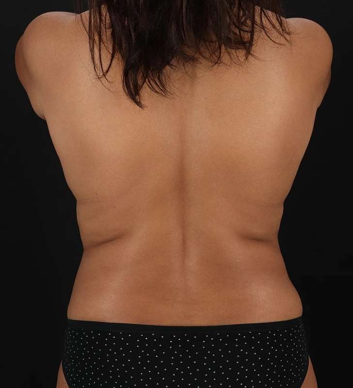 Tummy Tuck Before & After Patient #2424