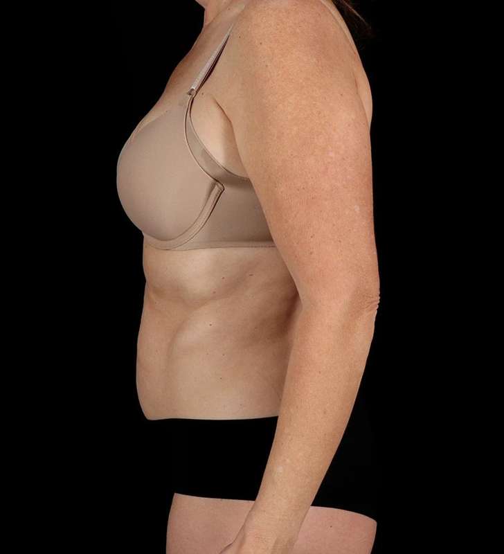 Tummy Tuck Before & After Patient #2435