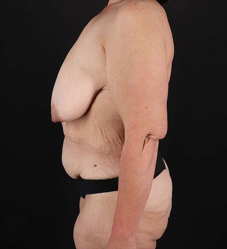 Tummy Tuck Before & After Patient #2461