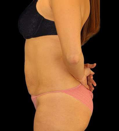Tummy Tuck Before & After Patient #2485