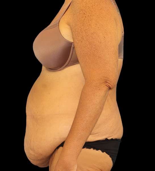 Circumferential Body Lift Before & After Patient #2509
