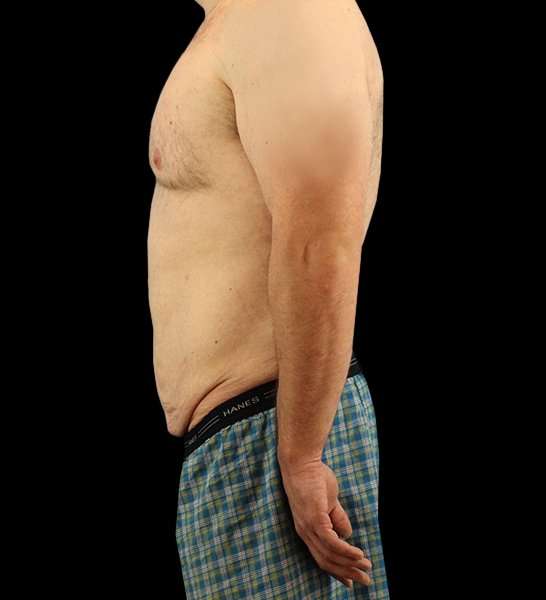 Circumferential Body Lift Before & After Patient #2522