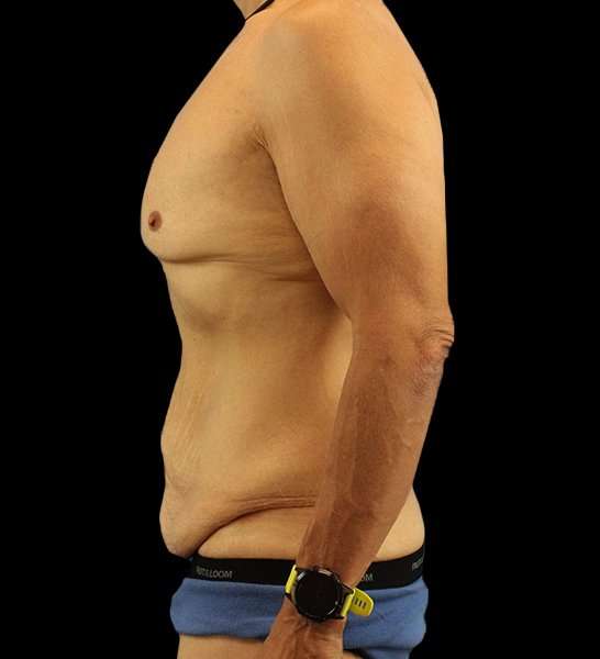 Circumferential Body Lift Before & After Patient #2535