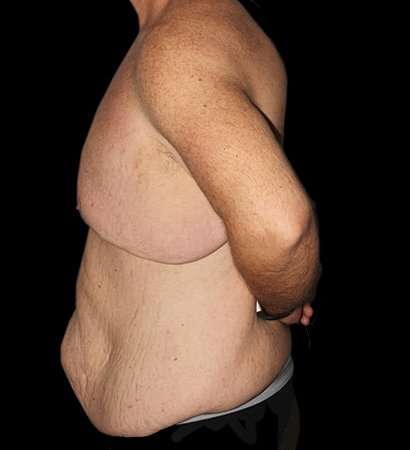 Massive Weight Loss Before & After Patient #5155