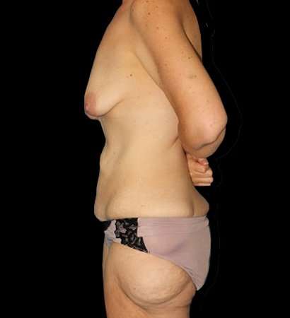 Circumferential Body Lift Before & After Patient #2559