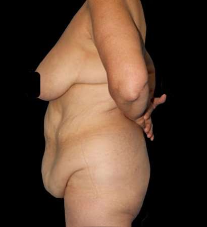 Circumferential Body Lift Before & After Patient #2572