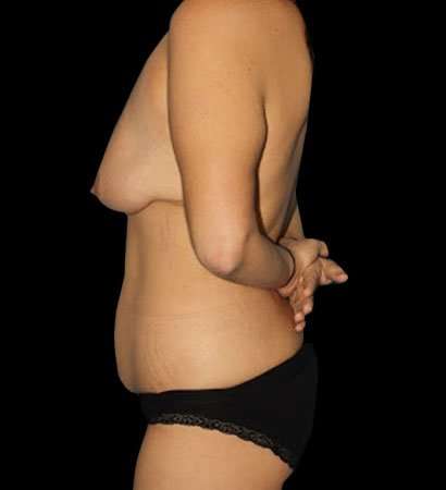 Circumferential Body Lift Before & After Patient #2585