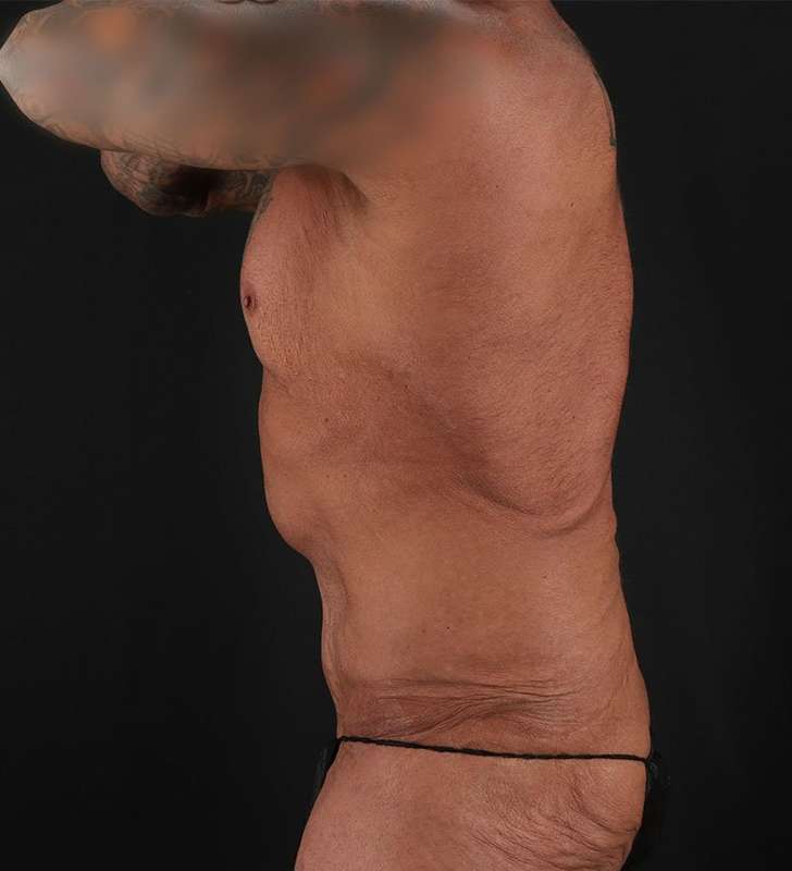 Circumferential Body Lift Before & After Patient #2611