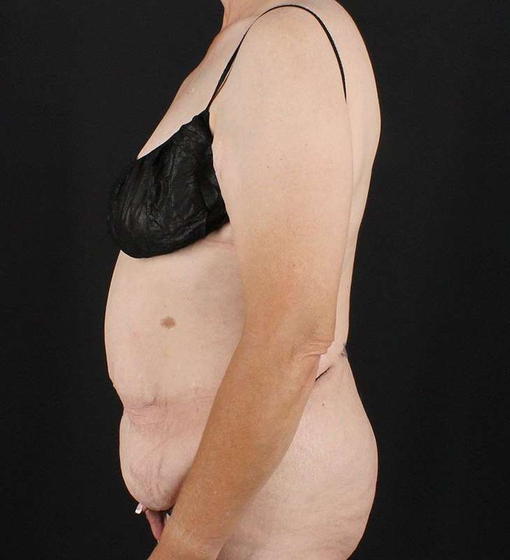 Circumferential Body Lift Before & After Patient #2624