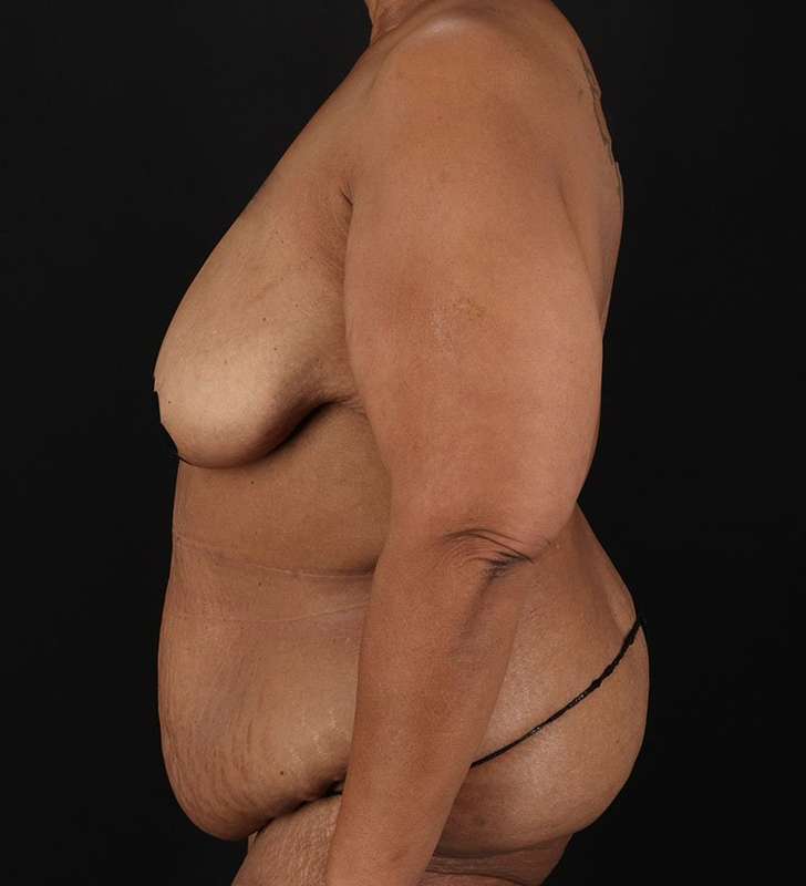 Circumferential Body Lift Before & After Patient #2637