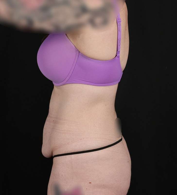 Circumferential Body Lift Before & After Patient #2650