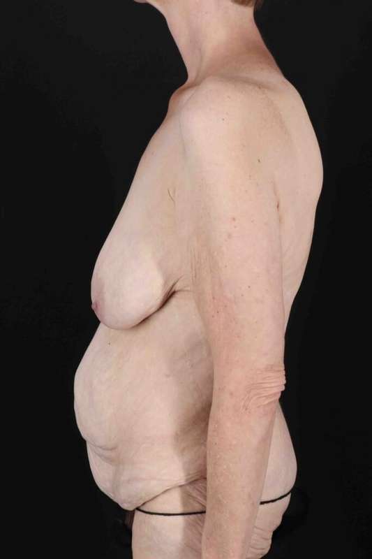 Circumferential Body Lift Before & After Patient #2663