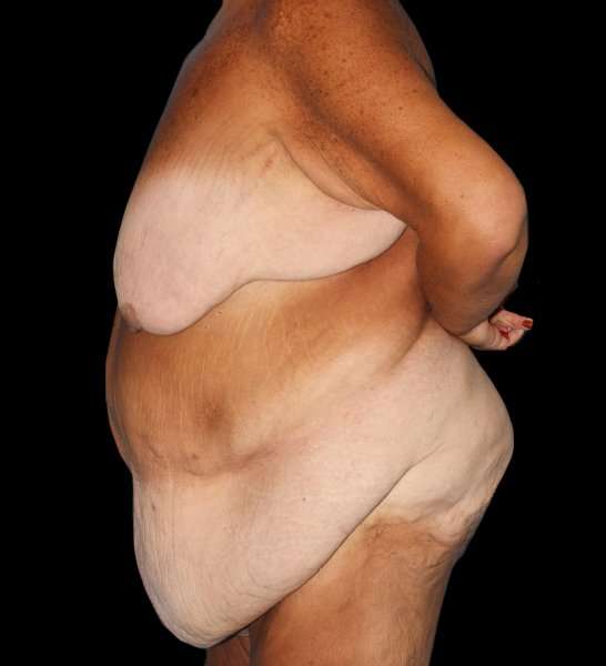 Fleur De Lis Circumferential Body Lift Before & After Patient #2674