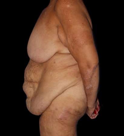 Fleur De Lis Circumferential Body Lift Before & After Patient #2685
