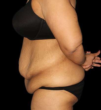 Fleur De Lis Tummy Tuck Before & After Patient #2703