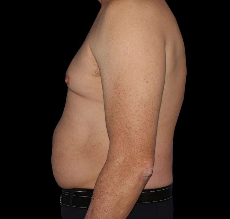 Liposuction Before & After Patient #2756