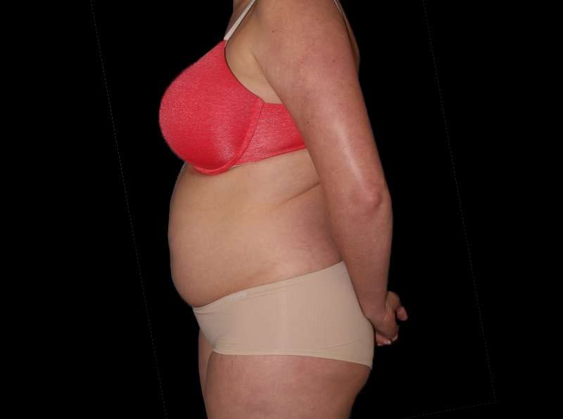 Liposuction Before & After Patient #2778