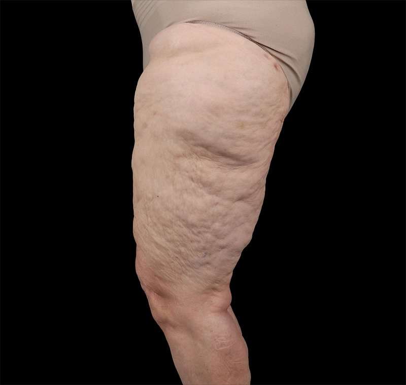 Liposuction Before & After Patient #2829