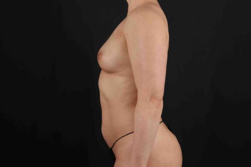 Liposuction Before & After Patient #2845