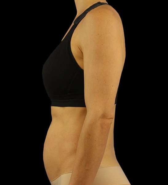 Mini Tummy Tuck Before & After Patient #2856