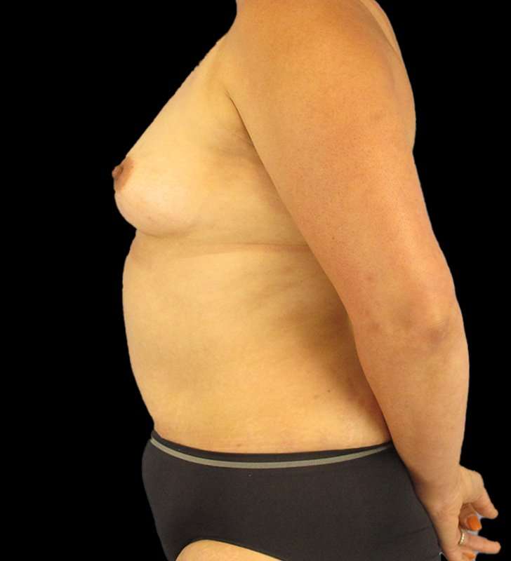 Mommy Makeover Before & After Patient #2878