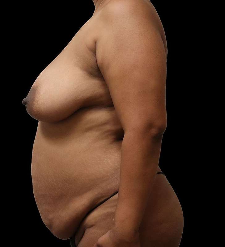 Mommy Makeover Before & After Patient #2926