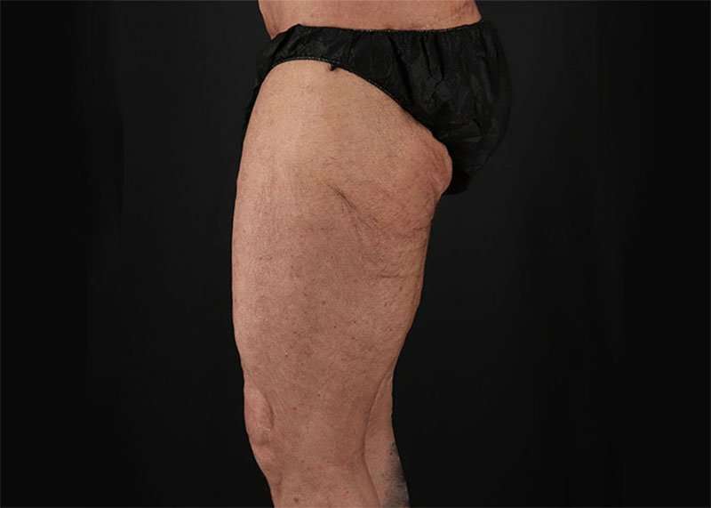 Thigh Lift Before & After Patient #2992