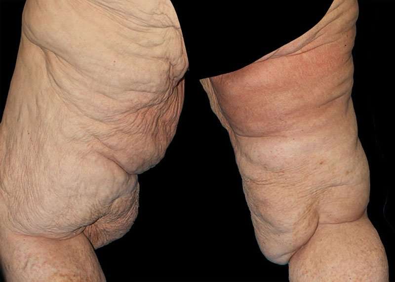 Thigh Lift Before & After Patient #3005