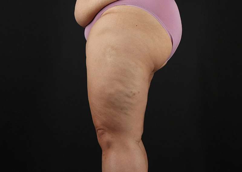 Thigh Lift Before & After Patient #3018