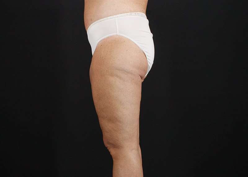 Thigh Lift Before & After Patient #3031