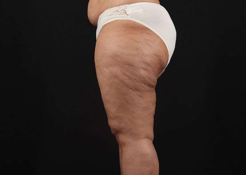 Thigh Lift Before & After Patient #3044