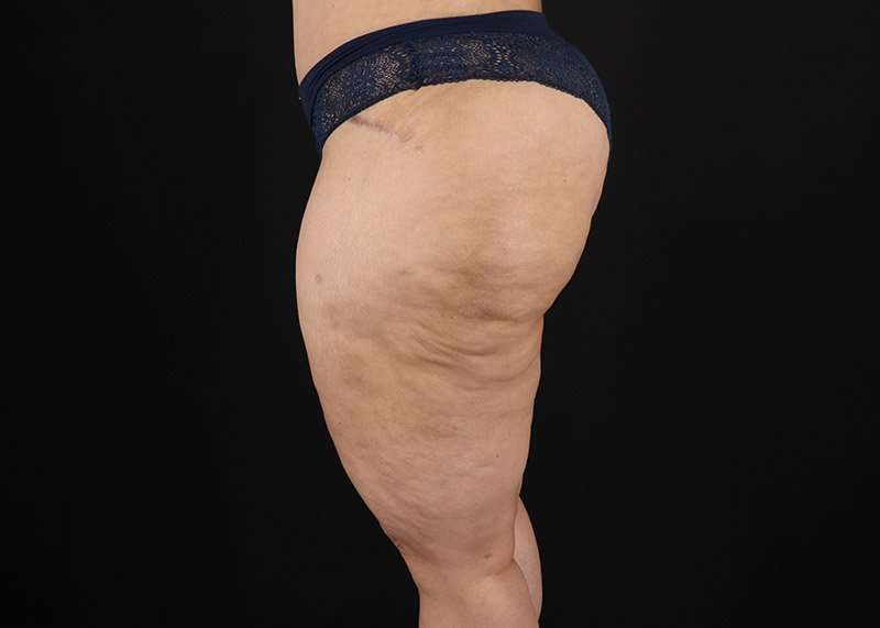 Thigh Lift Before & After Patient #3057