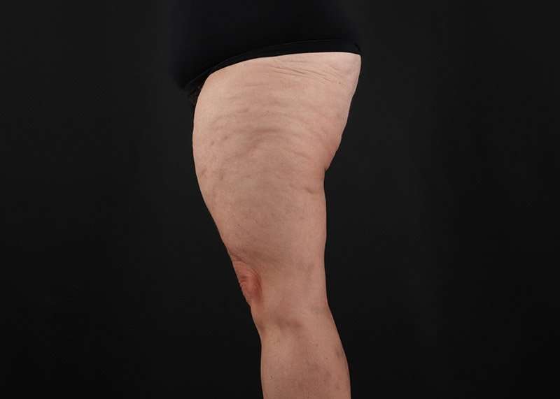 Thigh Lift Before & After Patient #3070