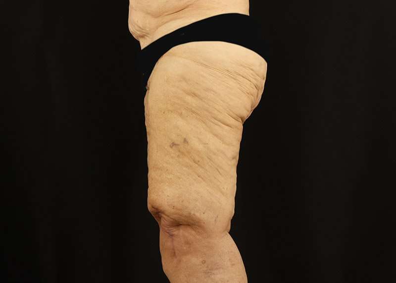Thigh Lift Before & After Patient #3083