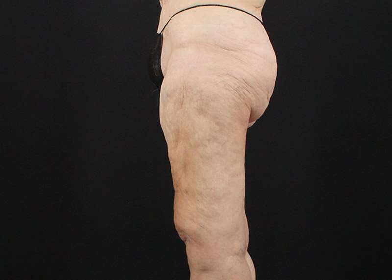 Thigh Lift Before & After Patient #3096