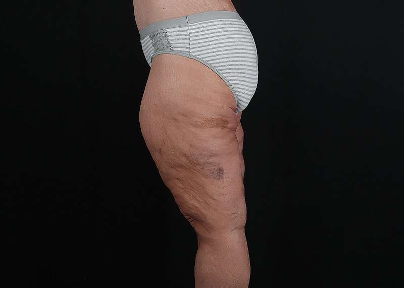 Thigh Lift Before & After Patient #3109