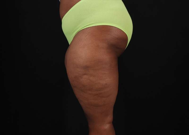 Thigh Lift Before & After Patient #3122