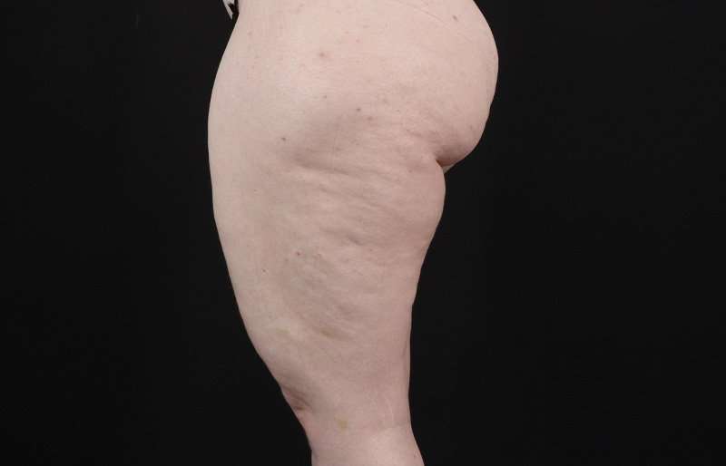 Thigh Lift Before & After Patient #3135
