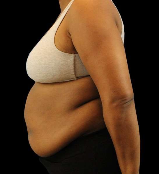 Tummy Tuck Revision Before & After Patient #3146