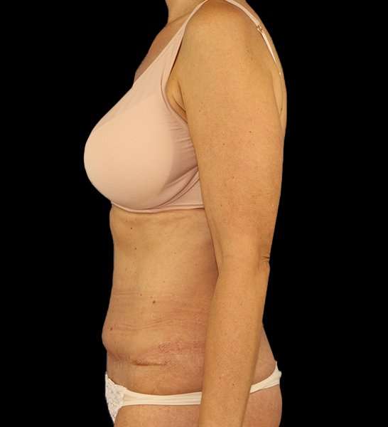 Tummy Tuck Revision Before & After Patient #3157