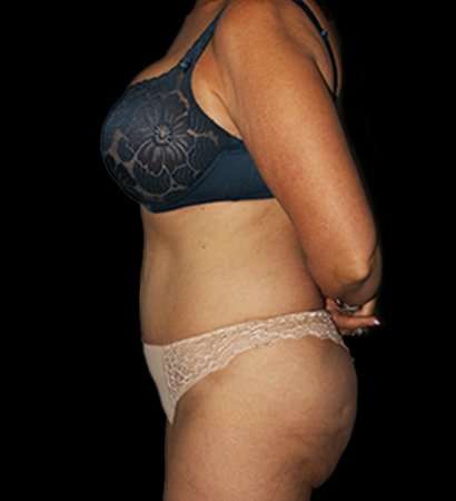 Tummy Tuck Revision Before & After Patient #3168