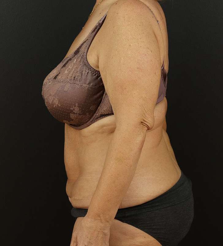 Tummy Tuck Revision Before & After Patient #3181