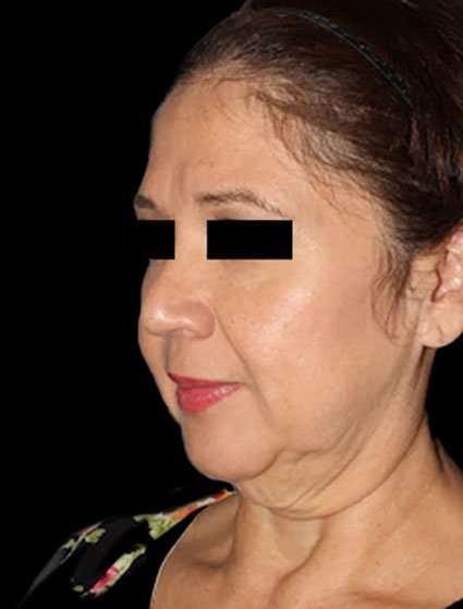 Face & Neck Lift Before & After Patient #3248