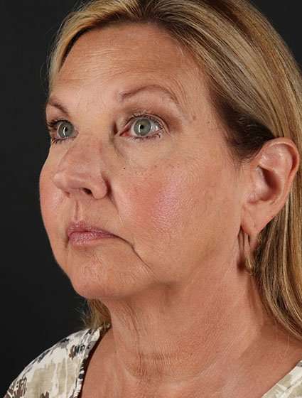 Face & Neck Lift Before & After Patient #3259