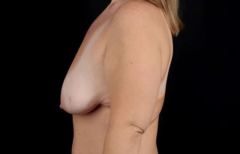 Breast Lift Before & After Patient #1140