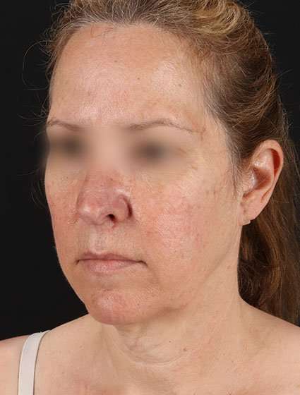 Face & Neck Lift Before & After Patient #3270